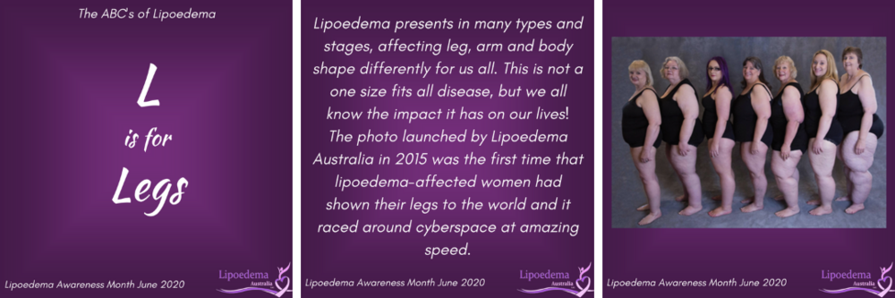 Living Well With Lipoedema